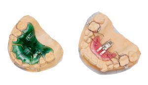 Aparaty ortodontyczne ruchome rne rodzaje. Kliknij aby powikszy.