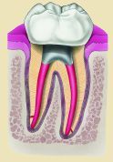 Zb martwy po leczeniu endodontycznym.