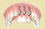 Trzy implanty plus trzy korony penoceramiczne.