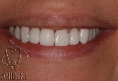 ortodoncja - wystajcy kie schowany do uku zbowego licwk