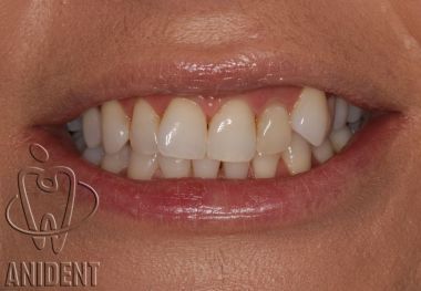 ortodoncja wystajcy kie
