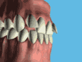 Retainer przyklejany na stałe do wewnętrznych powierzchni zębów. Kliknij aby powiększyć.