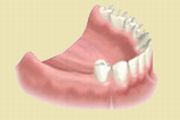 Brak zębów. Zaplanowano odbudowę na implantach.