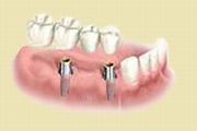 Most na dwóch implantach z dowieszonym zębem do tyłu.