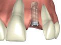 Implanty ceny, implant cena, implanty zębów cennik, implanty Warszawa koszt
