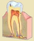 Nie leczona próchnica zęba prowadzi do leczenia kanałowego.