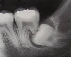 Ósemka może uszkodzić sąsiedni ząb - siódemkę.