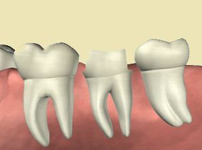 Ząb oszlifowany pod koronę protetyczną.