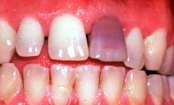 Ząb przebarwiony po leczeniu kanałowym - siny ząb.