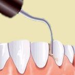 Skaling zębów - skaler ultradźwiękowy.