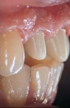 Ząb oszlifowany pod koronę protetyczną.