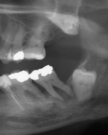 Ząb zatrzymany całkowicie w kości.