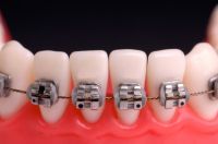 Metalowe lub kosmetyczne zamki ortodontyczne. Kliknij aby powiększyć.