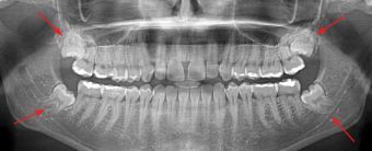 Zęby mądrości są widoczne na pantomogramie.