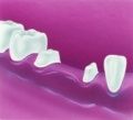 Zęby oszlifowane pod most protetyczny.8