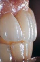 Ząb z koroną protetyczną LAVA.
