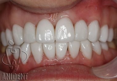 zacementowane licówki bez szlifowania na zęby górne i dolne