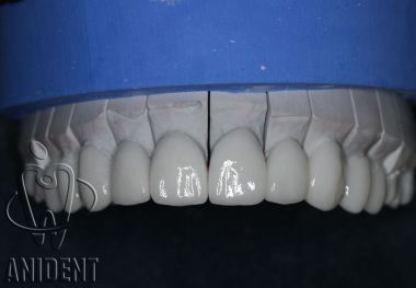 licówki bez szlifowania na modelu - gotowe do zacementowania na zębach pacjenta