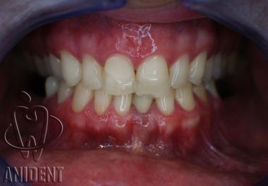 Zęby przed wykonaniem licówek porcelanowych bez szlifowania zębów.