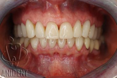 licówki na wszystkie zęby - naturalny kolor zębów
