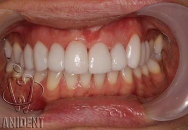 ząb schowany do łuku za pomocą licówki zamiast leczenia ortodontycznego